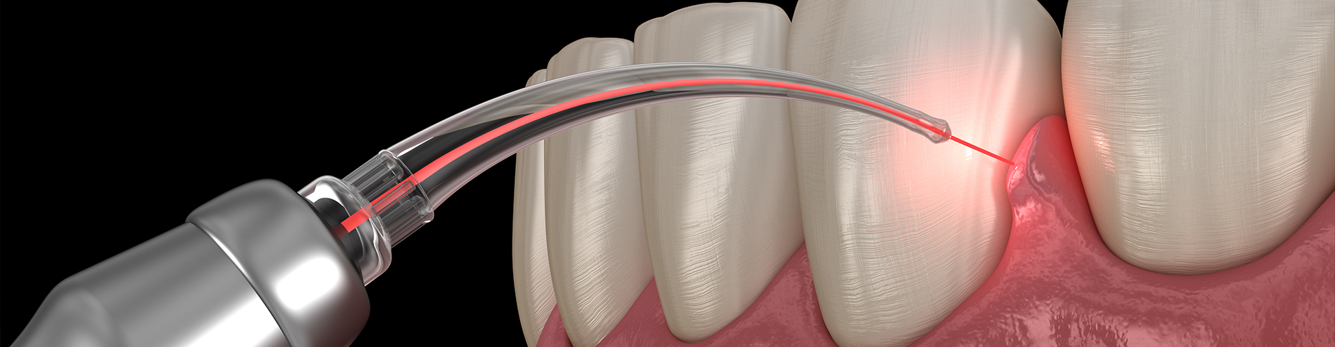 rendering of laser dental cleaning