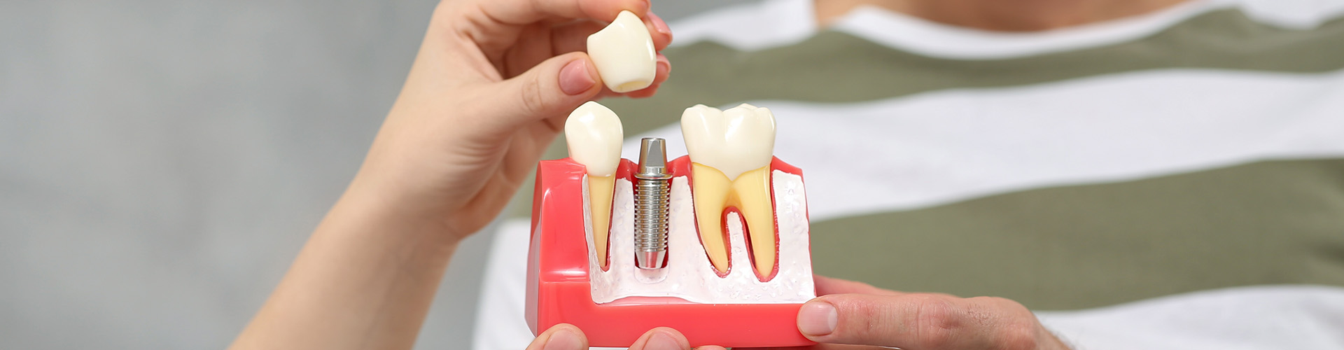 man holding teeth model while person demonstrates crowning an implant