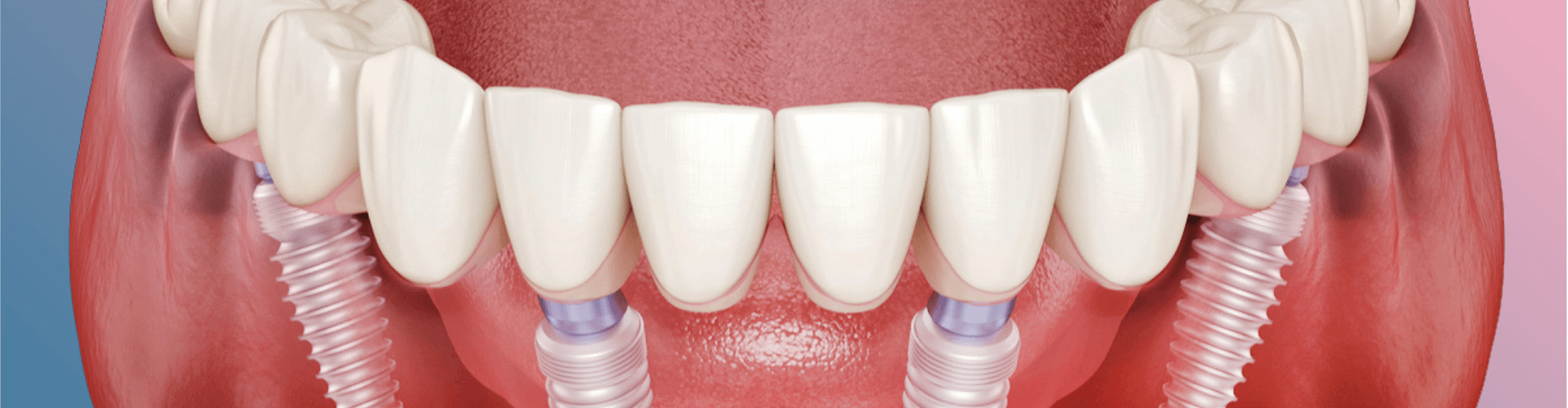 teeth in mouth with screws