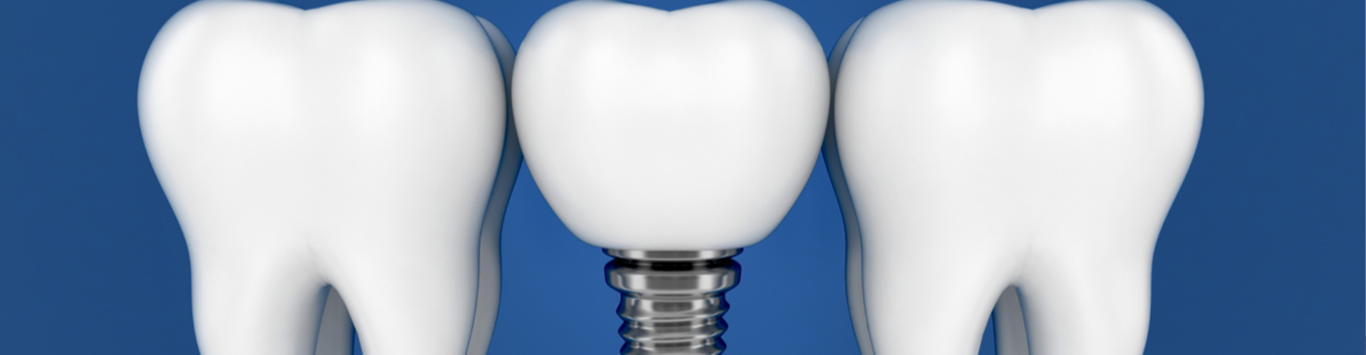 Animated picture of tooth with screw in the bottom