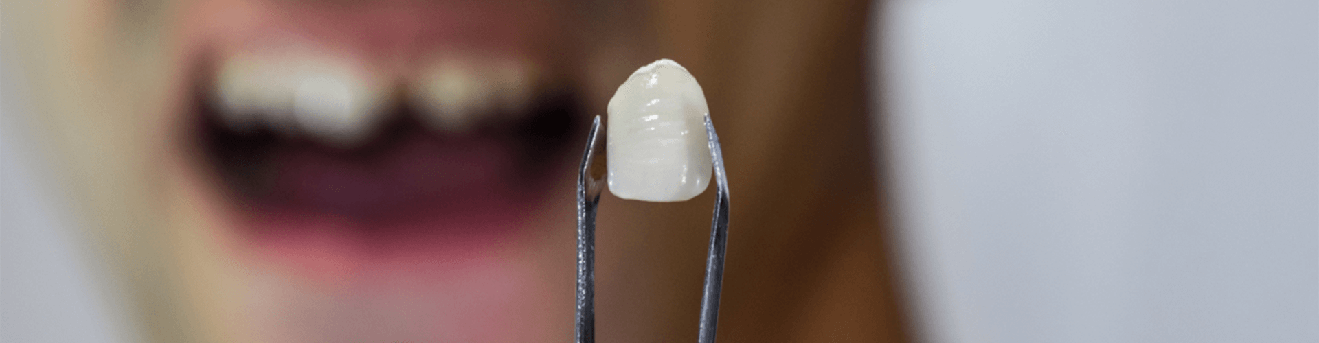 a tooth crown 