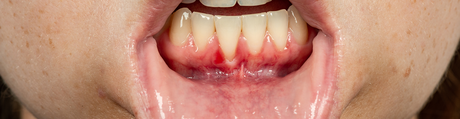 woman pulling down lower lip to show receeding gums