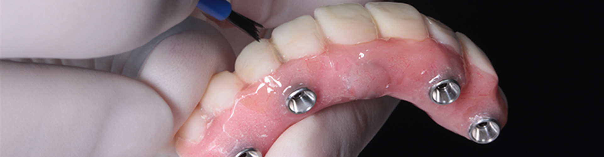 gloved hand holding upper implant-retained denture